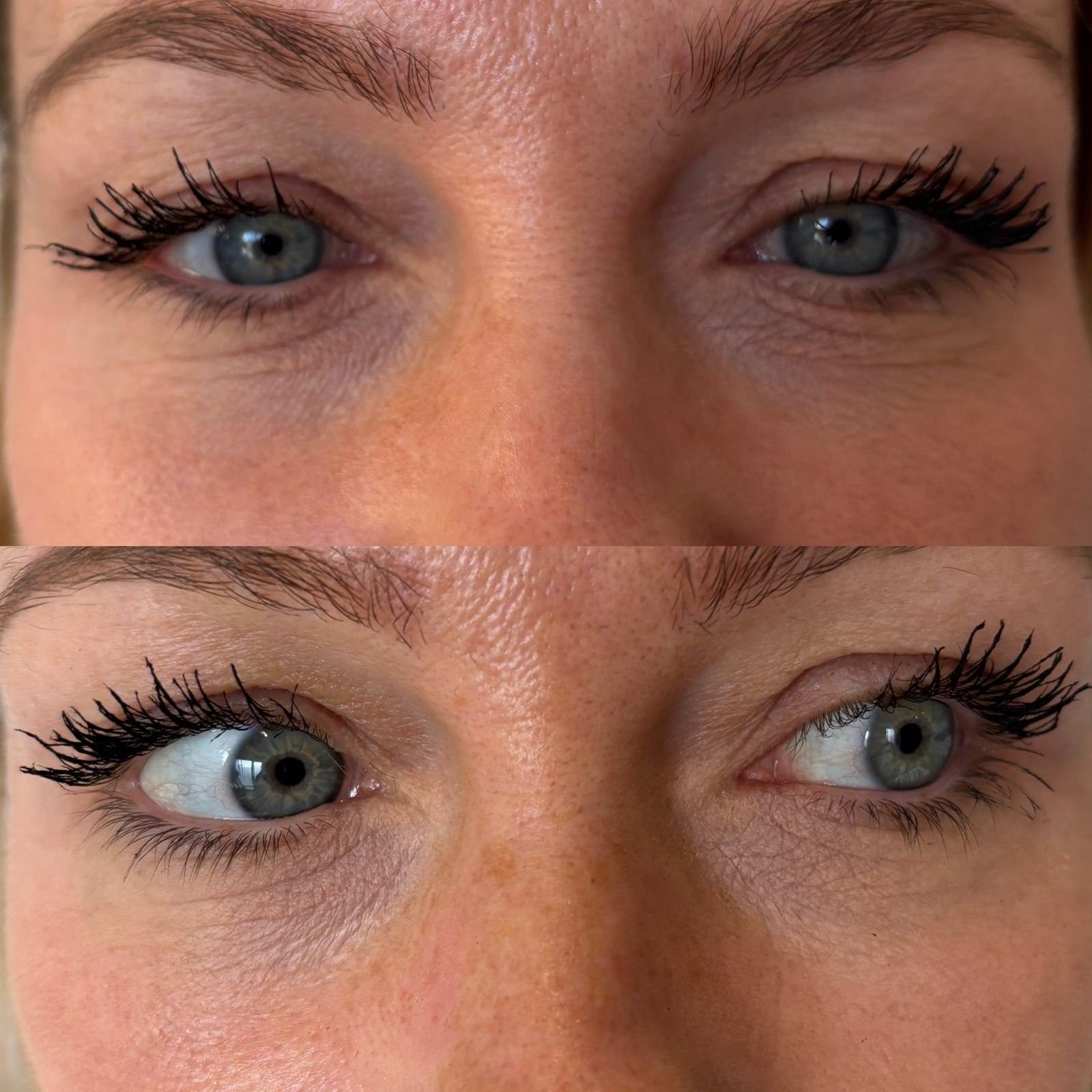Polynucleotides under-eye treatment, before and after