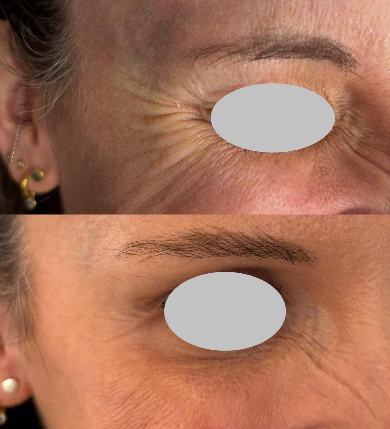 Anti-Wrinkle treatment, before and after