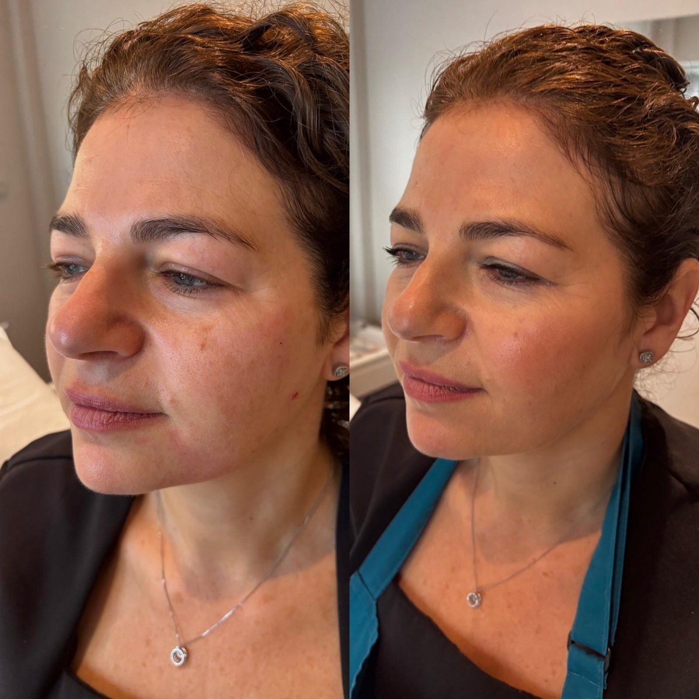 Cheek Filler, before and after