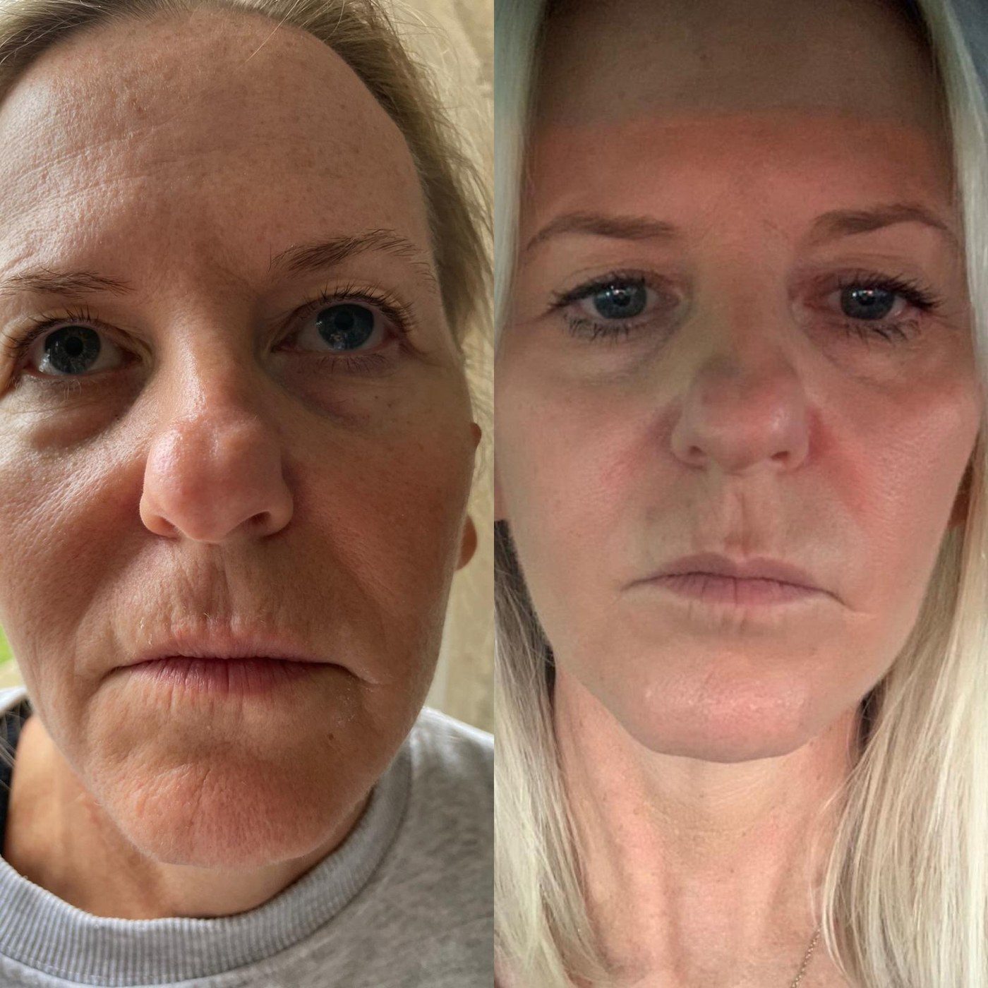 Full Face Rejuvenation, before and after