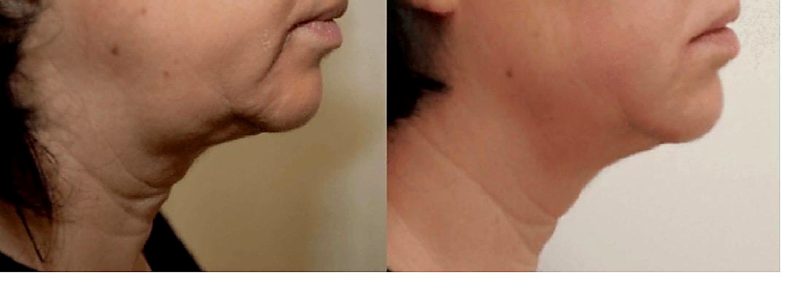 HIFU face and neck, before and after