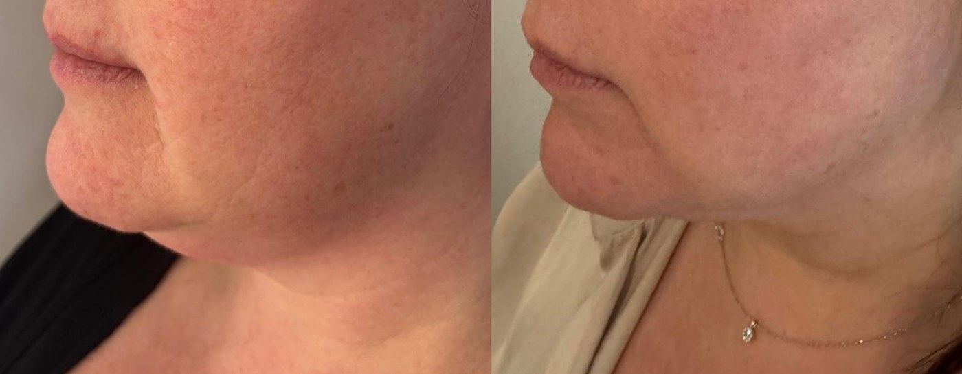 Jawline Definition, before and after