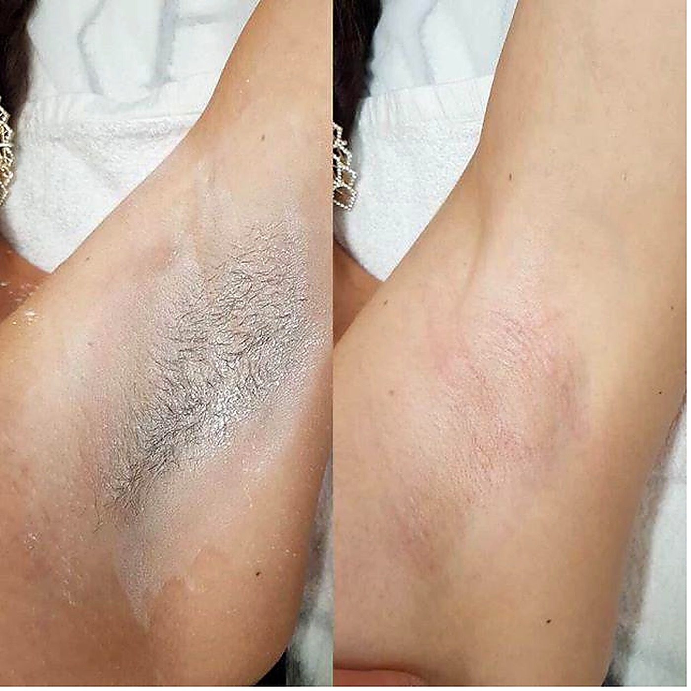 Laser hair removal, before and after