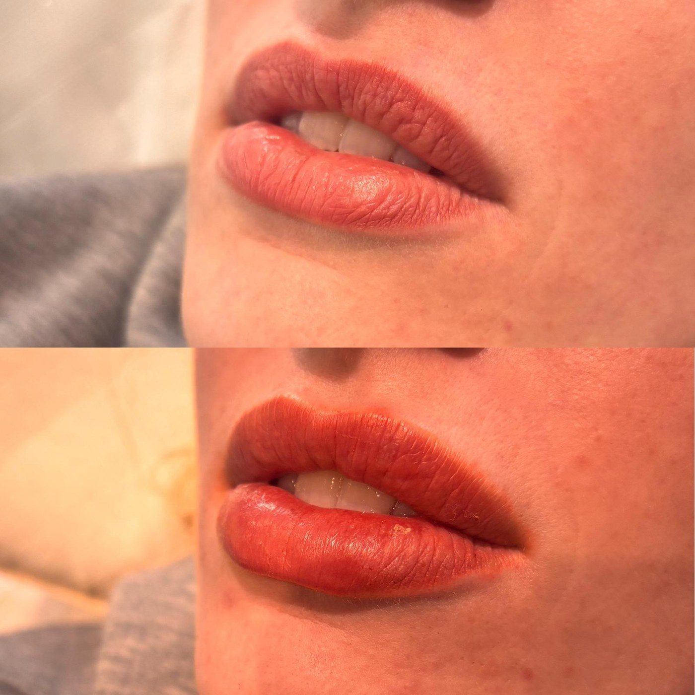 Lip Filler 0.5ml, before and after