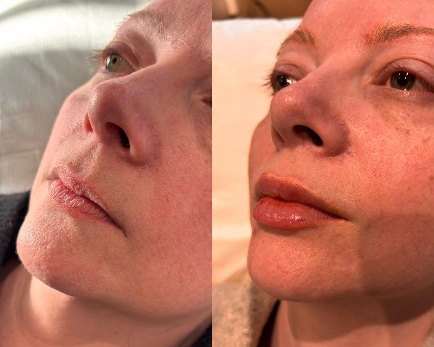 Lip Filler 1ml, before and after