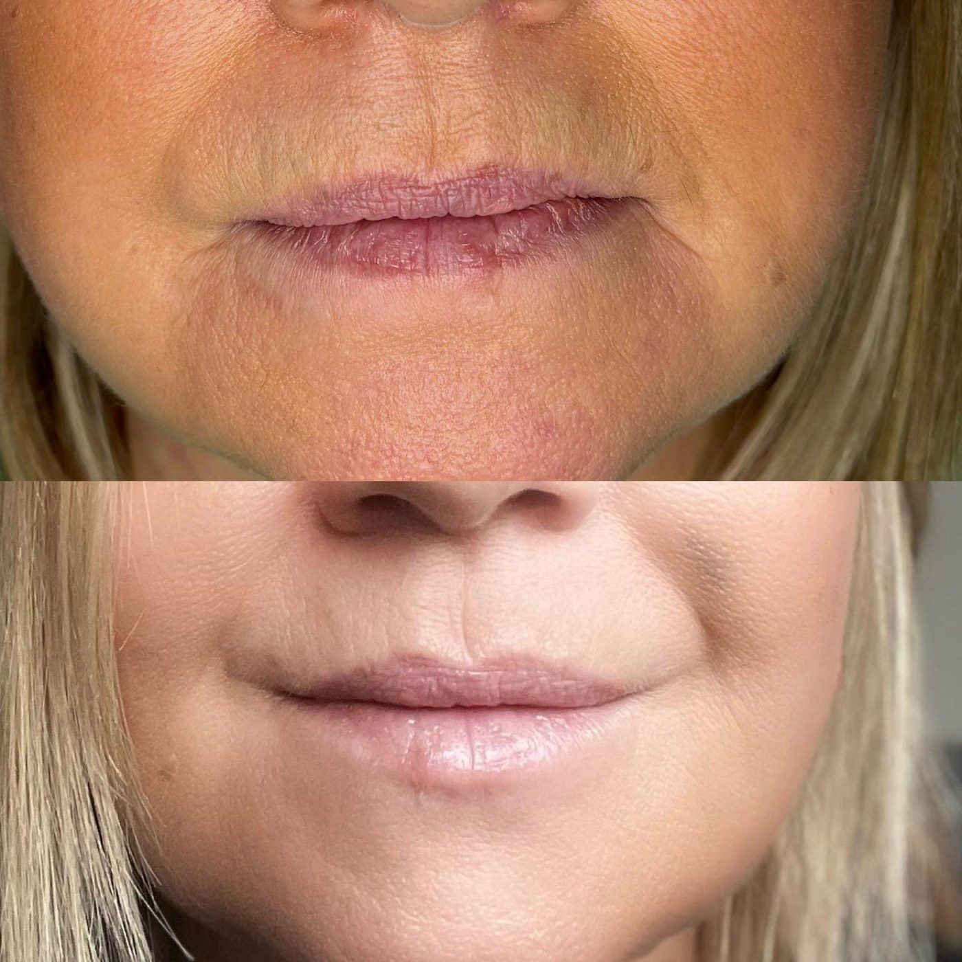 Lower Face Rejuvenation, before and after