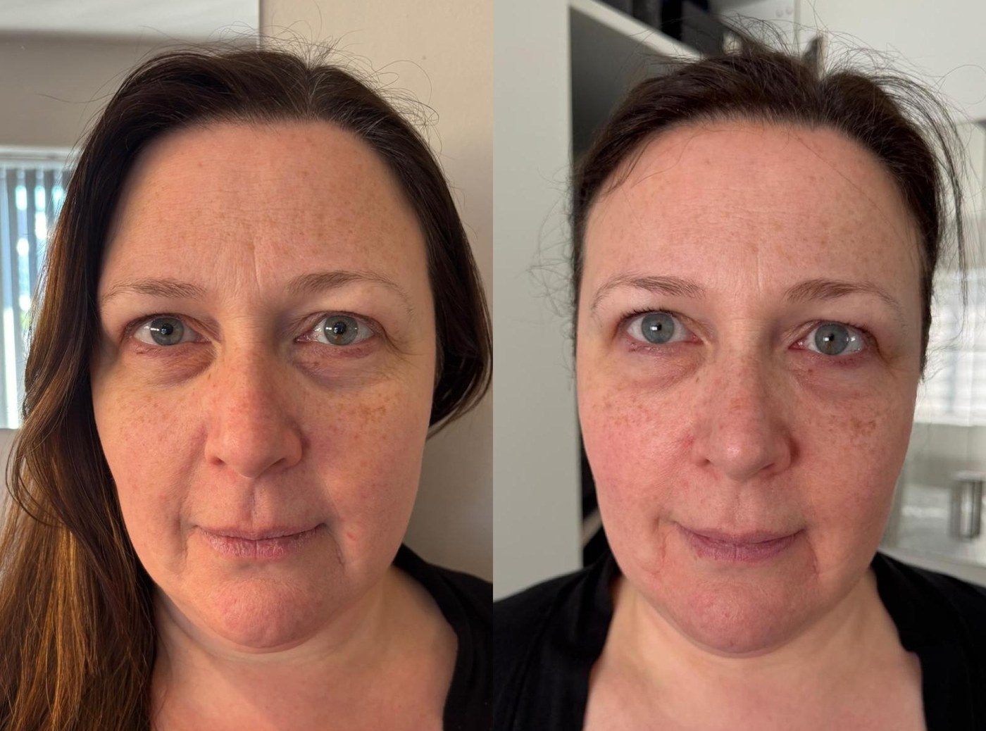 RF Microneedling, before and after