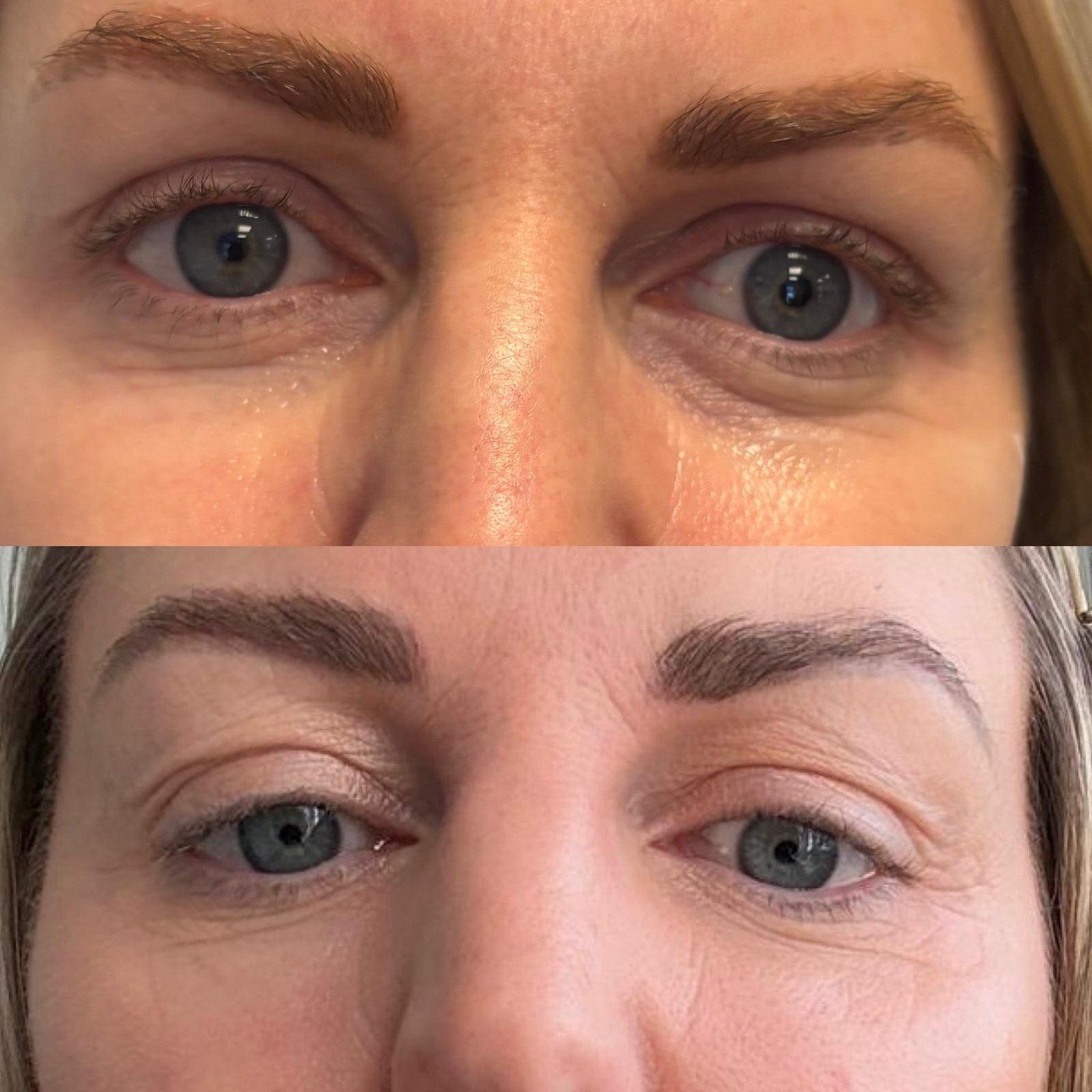 Tear Trough Filler, before and after